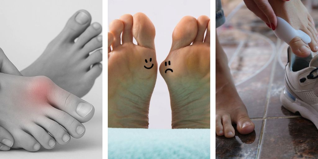 Hallux Valgus : comprendre et prévenir pour mieux vivre !